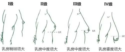 男性乳腺异常发育的原因及症状：激素失衡与触痛解析  第1张