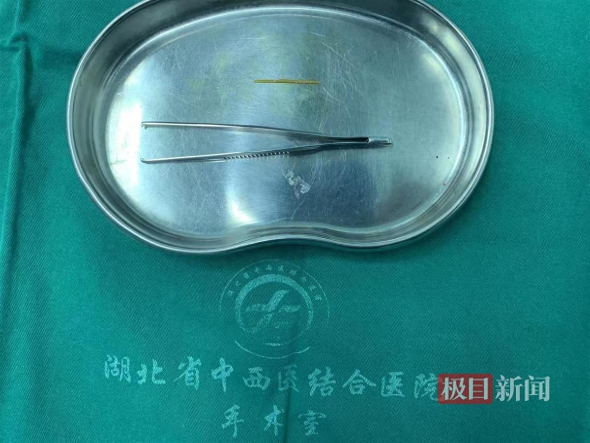 六旬老人误吞牙签险丧命，微创手术成功取出并缝合肠壁  第1张